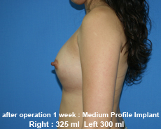 plastic-surgery-breast-augmentation